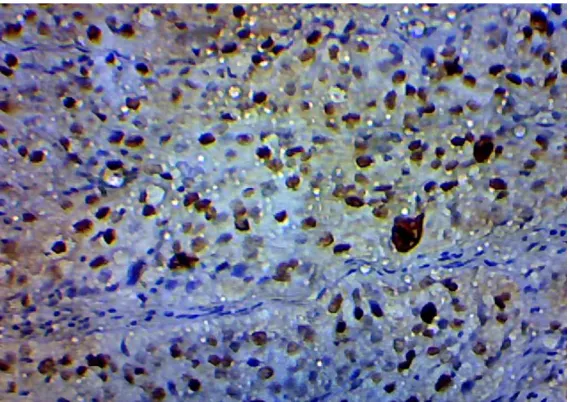 Fig. 2. Large cell non-keratinizing squamous cell carcinoma showing +3 positivity to Ki67 antibody