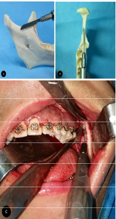 Fig. 5. The splitted ramus. Note the same thickness of bone in all length of buccal cortex 