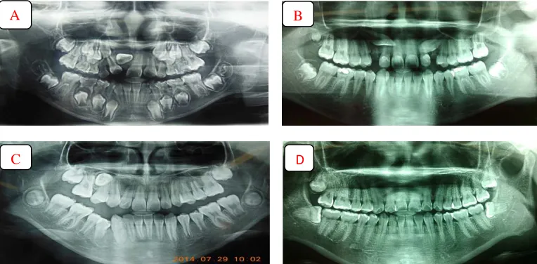 Fig. 1. Radiographs image of impacted tooth (A: Maxillary incisal impacted tooth; B: Maxillary canines impacted teeth; C: Maxillary second premolar impacted tooth and D: maxillary and mandibular molar impacted teeth) 