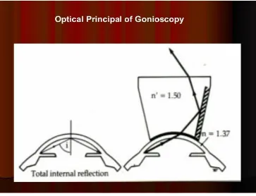 Figure 7: Diagram Showing the Principle of Gonioscopy 