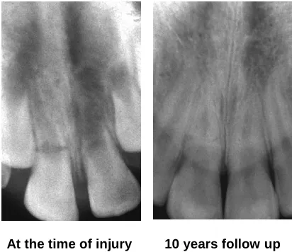 Fig. 2. Complicated crown root fracture [56]  