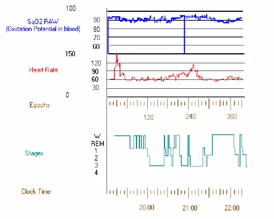 Fig. 6.1: Variations in recordings from the polysomnogram instruments. 