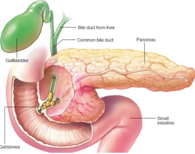 Figure 5. Gallstone causing pancreatitis 