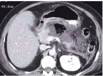 Figure 11.Infected Pancreatic Necrosis. The air bubble in necrotic debris indicates infected necrosis 