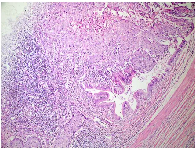 Fig. 1. Non-invasive low-grade, epithelial  changing tumour of the bladder. (x100, HE) 