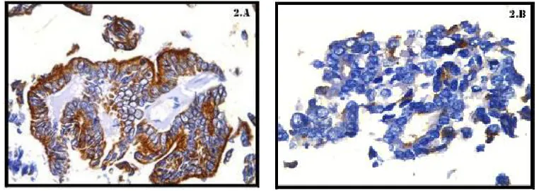 Fig. 2. Immunostaining of Ret in papillary thyroid carcinoma and in its variant A. FNA cell block of PTC showing strong and diffuse positivity of Ret (40X) B
