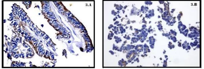 Fig. 3. Immunostaining of HBME-1 in papillary thyroid carcinoma and follicular thyroid 
