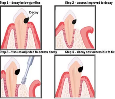 Fig. 1. A simple illustration of the procedure of crown lengthening involving the reflection of  the gingiva and trimming of the bone 