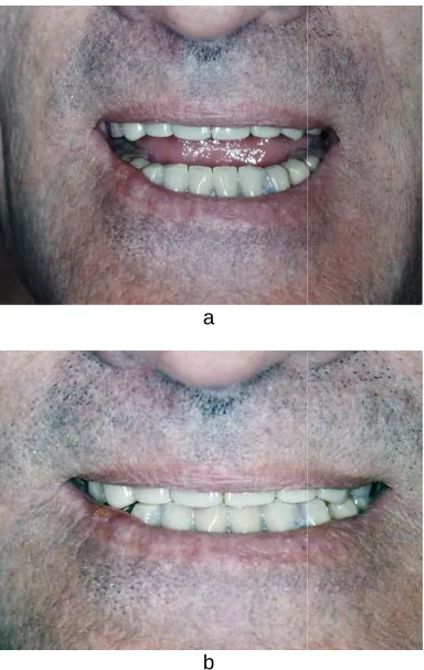 Fig. 4. (a) and (b) Technical work of overdenture with Comsteel 444 retention magnetic 