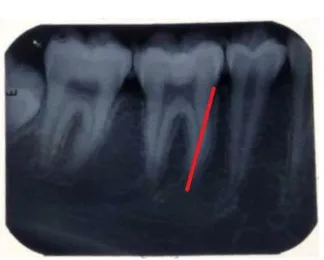 Figure 10 – Width of the Pulp At Cemento-enamel Junction 