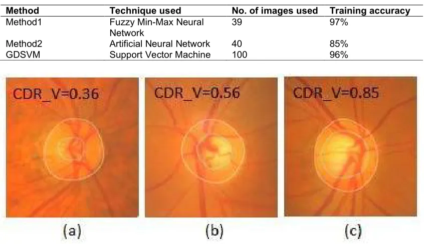 Fig. 6. Different stages of Glaucoma 