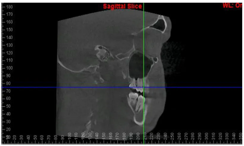 FIGURE 2 : SAGITTAL VIEW CBCT SLICE 