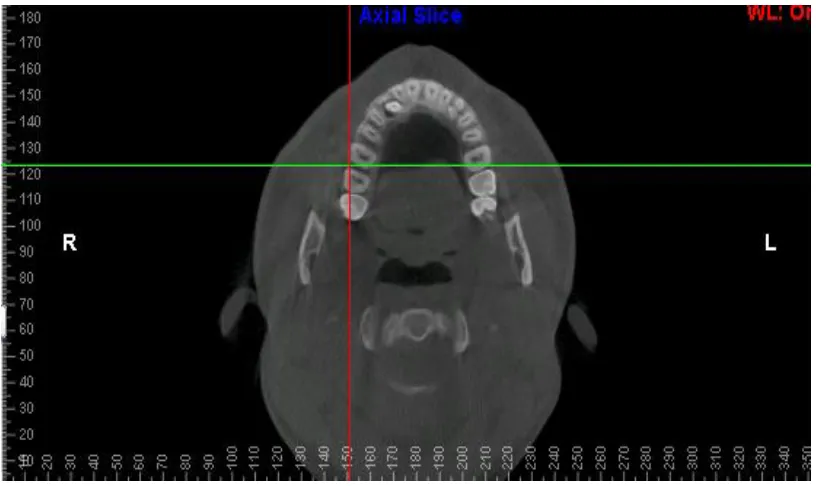 FIGURE 4 : AXIAL VIEW CBCT SLICE