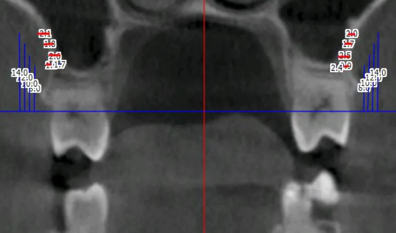 FIGURE 6: MIDDLE OF MAXILLARY FIRST MOLAR – 6 MIDDLE 