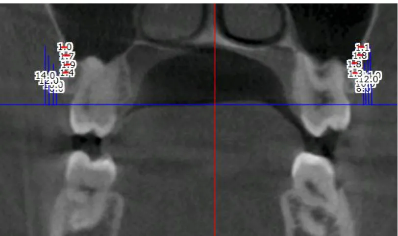FIGURE 8: MIDDLE OF MAXILLARY SECOND MOLAR – 7 MIDDLE 