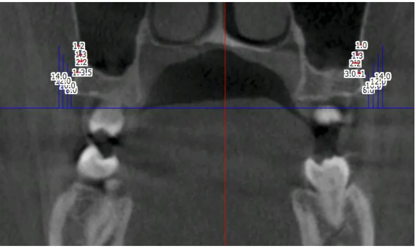 FIGURE 9:  DISTAL OF MAXILLARY SECOND MOLAR – 7 DISTAL 