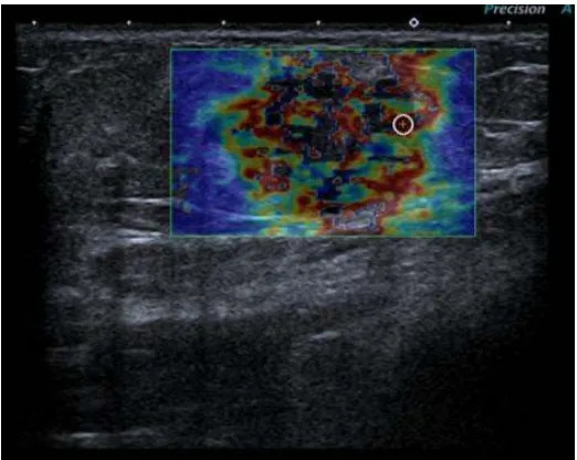 Fig. 1. Palpable right breast mass, ultrasonographic appearance of   pathologic intramamarian lymph node 