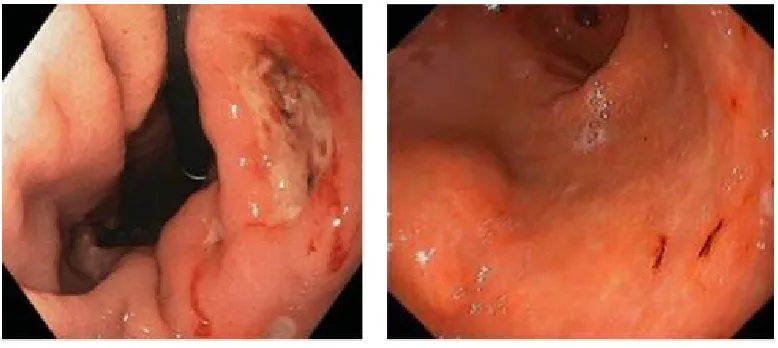 Fig. 1. gastric ulcer on endoscopy 