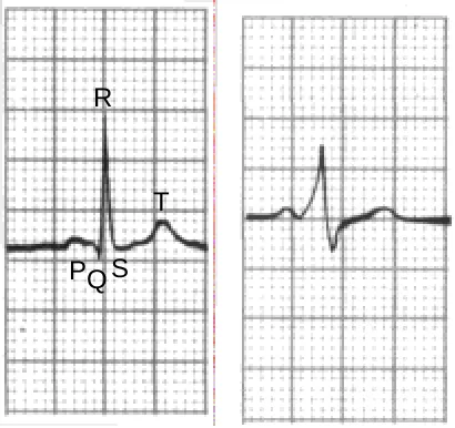 Figure 1: Two sample ECG traces.