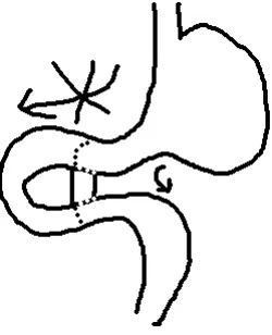 Figure 4: Stomach operation sketch.