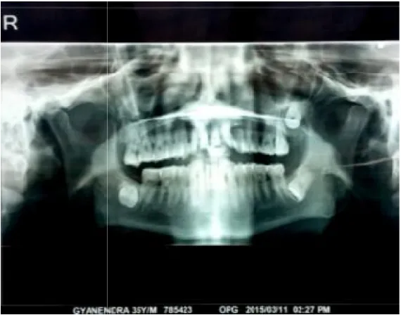 Fig. 3. Ortho Pantomo Gram 