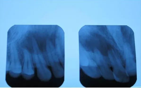 Fig. 1. Pre-Operative - Upper right central and lateral incisors were slightly discolored but there was no mobility, no swelling and no pus exudation