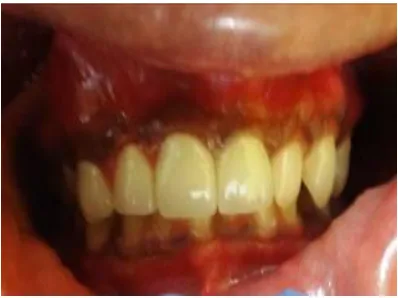Fig. 7. Healing-Proper healing as seen in intra-oral peri-apical radiograph 