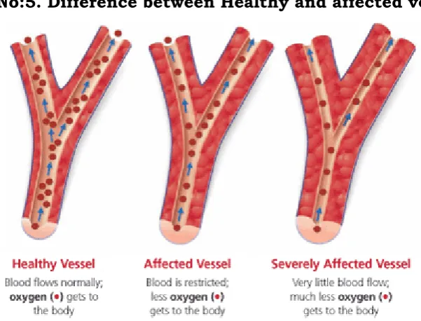 Fig.No:5. Difference between Healthy and affected vessel 