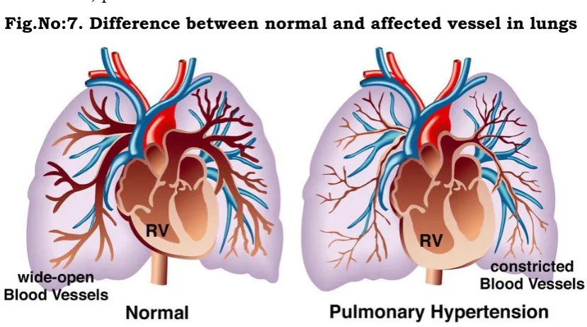 Fig.No:6. Pulmonary vascular changes in PAH leading to RV strain  