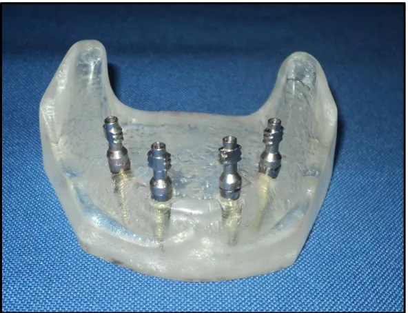 Fig 15. The open tray impression copings screwed to the multi-unit abutment 
