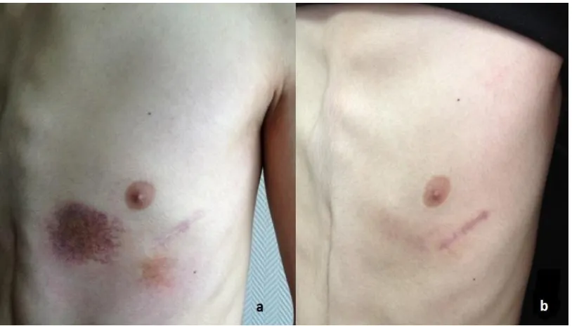 Fig. 1. a) The ecchymosis at first admission and b) the appearance of chest wall 2 weeks later 