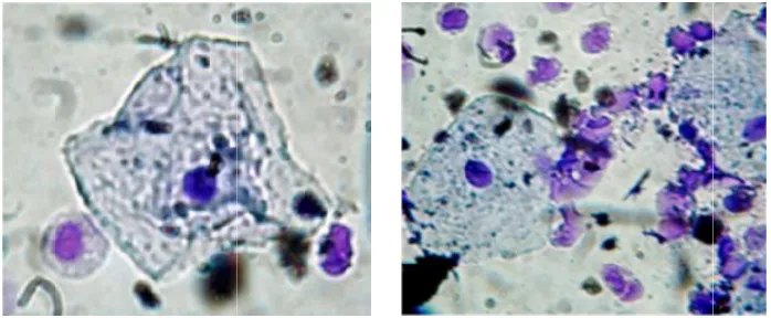 Fig. 3. Accumulation of inflammatory cells in lining flammatory cells in lining mouth of smokers, stained with Giemsa stain, (400X)