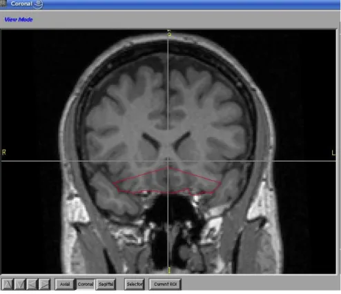 Fig 3: OFC tracing 