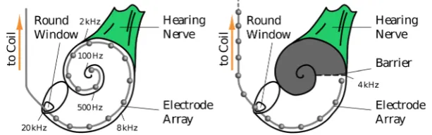 Figure 4. Ideal and problematic cochlear implant electrode insertion. The cochlea in which it is not possible to insert the electrode array to a full or even its left-hand picture displays the ideal insertion of a cochlear implant electrode array
