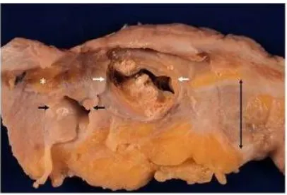 Fig. 3. View from the peritoneal surface of folded omentum obturating an abdominal  wall defect 
