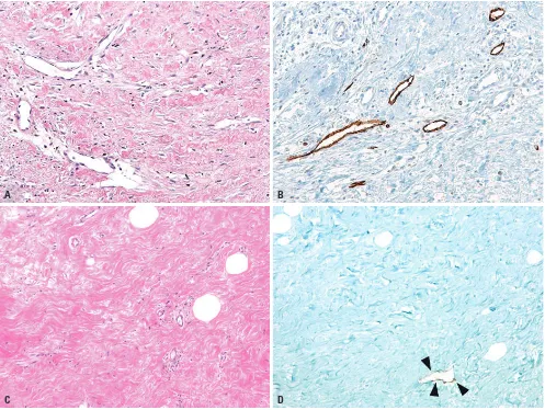 Fig. 1. Lymphangiogenesis in fibrous stroma in tumor with high elasticity value and low elasticity value