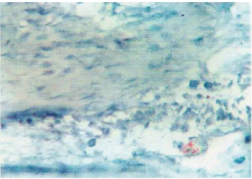 Fig. 1. Immunohistochemical staining for c­Myc showing mild focal reaction in the peripheral cells of a case of benign follicular ameloblastoma [ABC­DAB X250) 