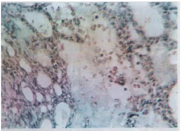 Fig. 2. Immunohistochemical staining for c­Myc revealing mild focal reaction in the peripheral cells of a case of benign follicular ameloblastoma [ABC­DA B X250]  
