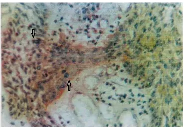 Fig. 4. Immunohistochemical staimng for c­Myc revealing focal distributed cytoplasmic reaction in malignant ameloblastoma (plexiform type) [ABC­DAB X250] 