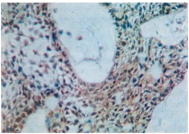 Fig. 6. Immunohistochemical staining for c­Myc revealing diffuse cytoplasmic reaction in  malignant ameloblastoma (plexiform type) [ABC­DAB XOil immersion)  