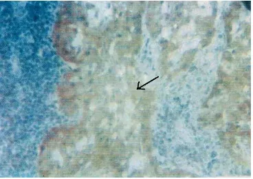 Fig. 8. Immunohistochemical staining of a rare case of ameloblastic carcinoma  metastases in  the cervical lymph  node, revealing  the strong total immune reactivity of c­Myc in the peripheral cell cytoplasms; Notice the mild to negative central cells reactivity revealing foci of necrotic cellular degeneration (arrow) associated with high grade of malignancy                          [ABC­ DAB, X450] 