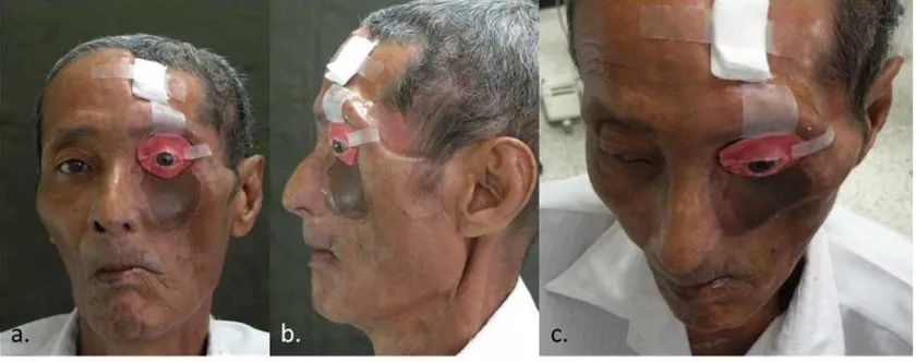 Fig. 1. Extra oral view: a. right lateral, b. frontal and c. left lateral 