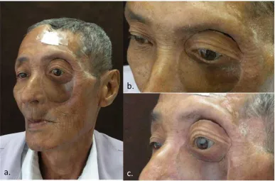 Fig. 8. Final prosthesis: a. right lateral view b. frontal view c. left lateral view 