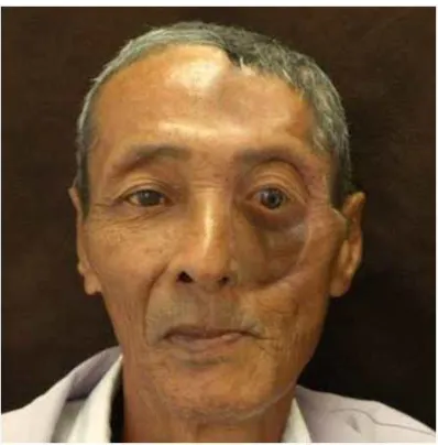 Fig. 9. Final prosthesis: 1 year after follow up 