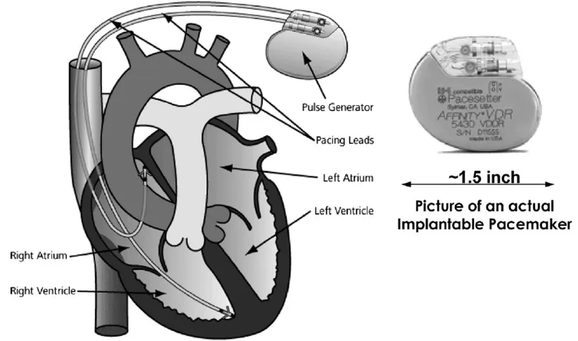 Fig. 1.1.  An implantable cardiac pacemaker device [1]. 