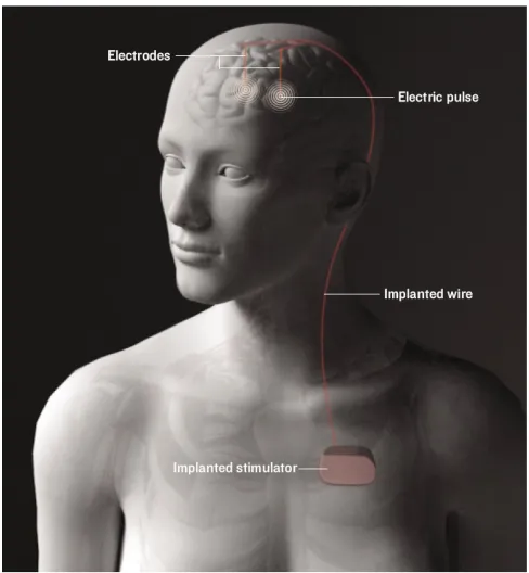 Fig. 1.3.  A state-of-the-art implanted deep brain stimulator [5]. 