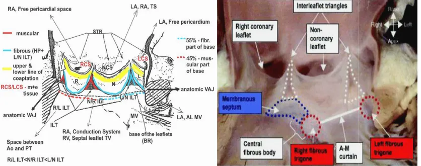 Fig. 2. A.B. Anatomic structures of aortic root which playFig. 2. A.B. Anatomic structures of aortic root which plays role in function of aortic valve