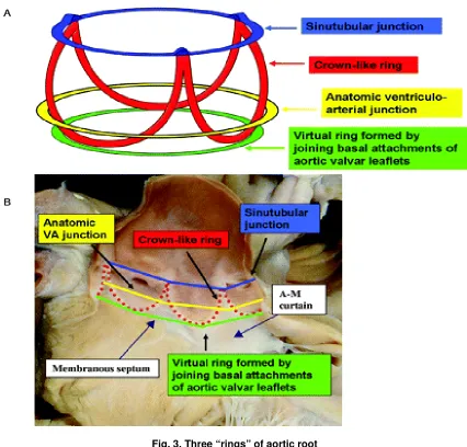 Fig. 3. Three “rings” of aortic root 