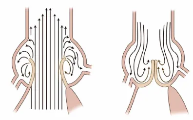 Fig. 4.  Importance of sinuses of valsalva 