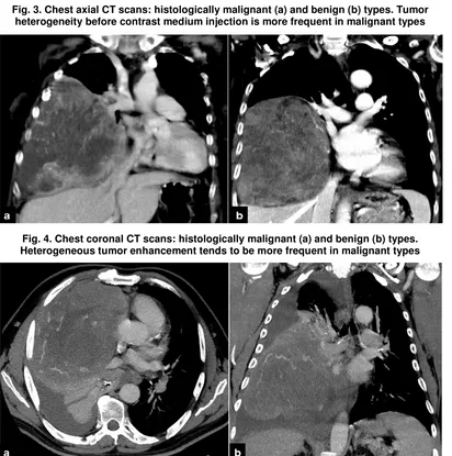 Fig. 3. Chest axial CT scans: histologically malignant (a) and benign (b) types. Tumor heterogeneity before contrast medium injection is more frequent in malignant types 